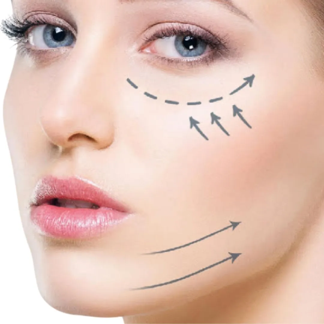 Endolift®
