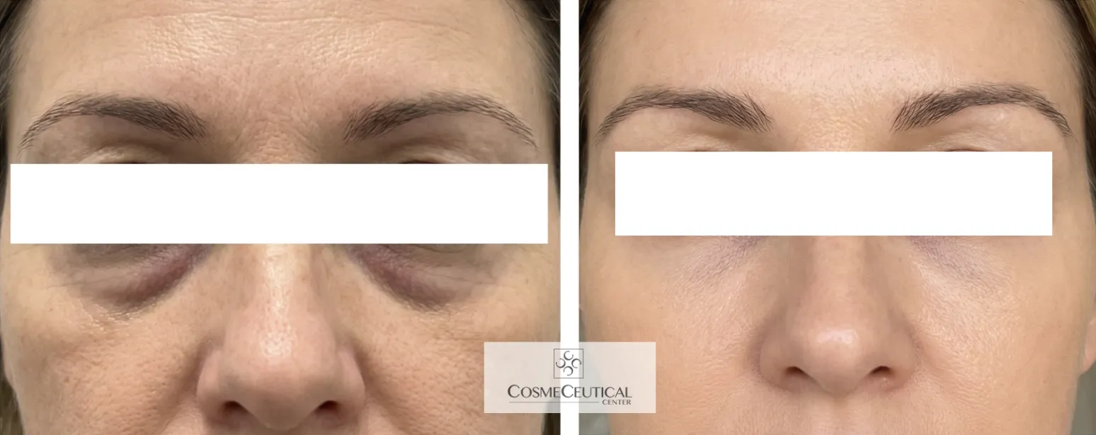 Antes y después · Ojeras