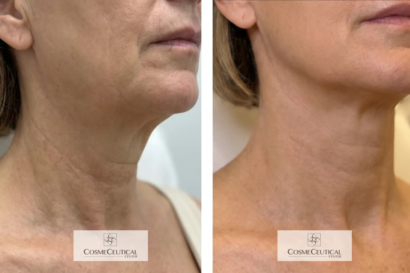 Antes y después · Cuello