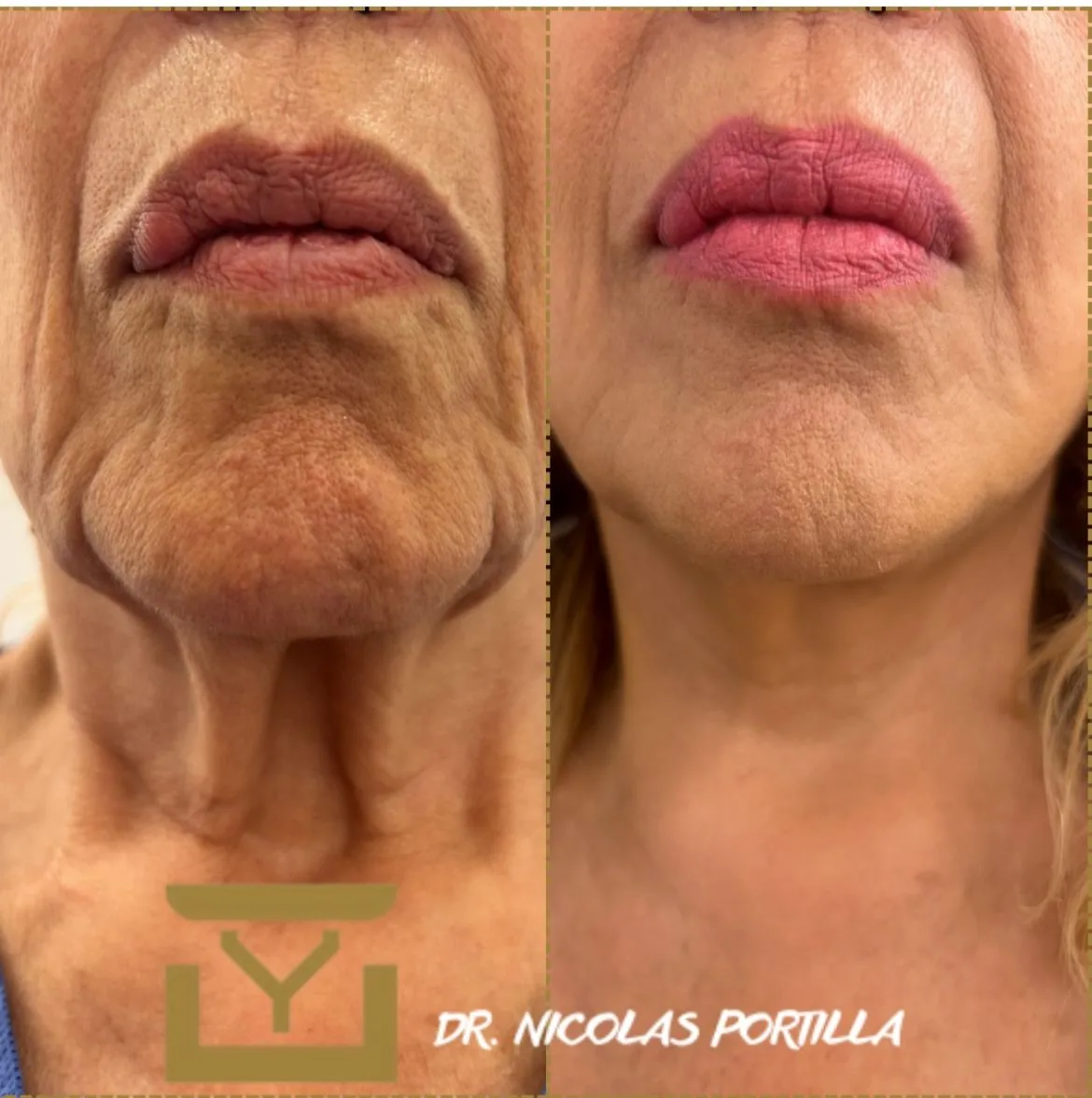 Antes y después · Papada