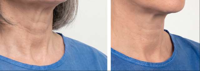 Cuello antes y después del tratamiento
