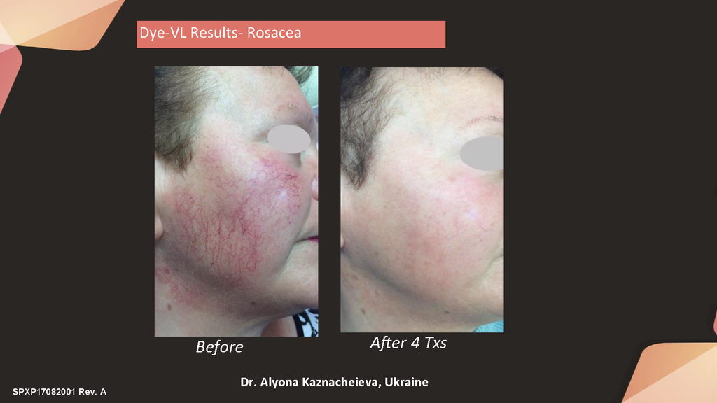 HarmonyXL Pro-Dye Mov. Rostro o Escote