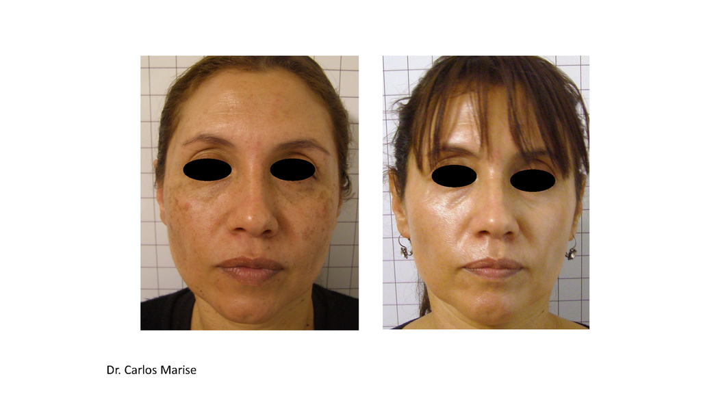 HarmonyXL Pro-Dye Mov. Rostro o Escote