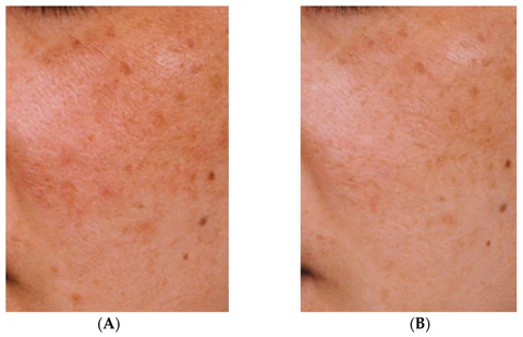 Tranexamic Acid 4% de la marca Universkin: Resultados