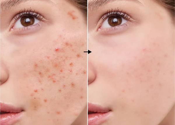 Ácido Azelaico 5.4% de la marca Universkin: Resultados