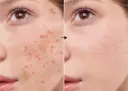 Ácido Azelaico 5.4% de la marca Universkin: Resultados
