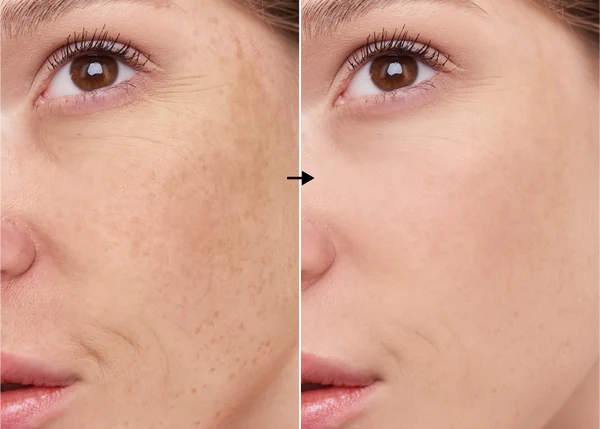 Ácido Ferúlico 1% de la marca Universkin: Resultados