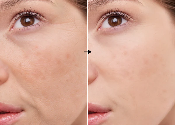 Isoflavonas 2% de la marca Universkin: Resultados