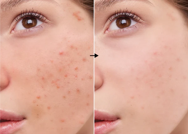 Lactopeptide 3.5% de la marca Universkin: Resultados