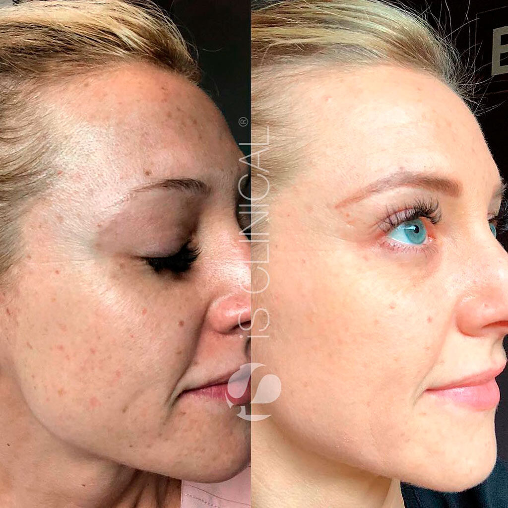 Is Clinical - Prodigy Peel System Pro (P3)