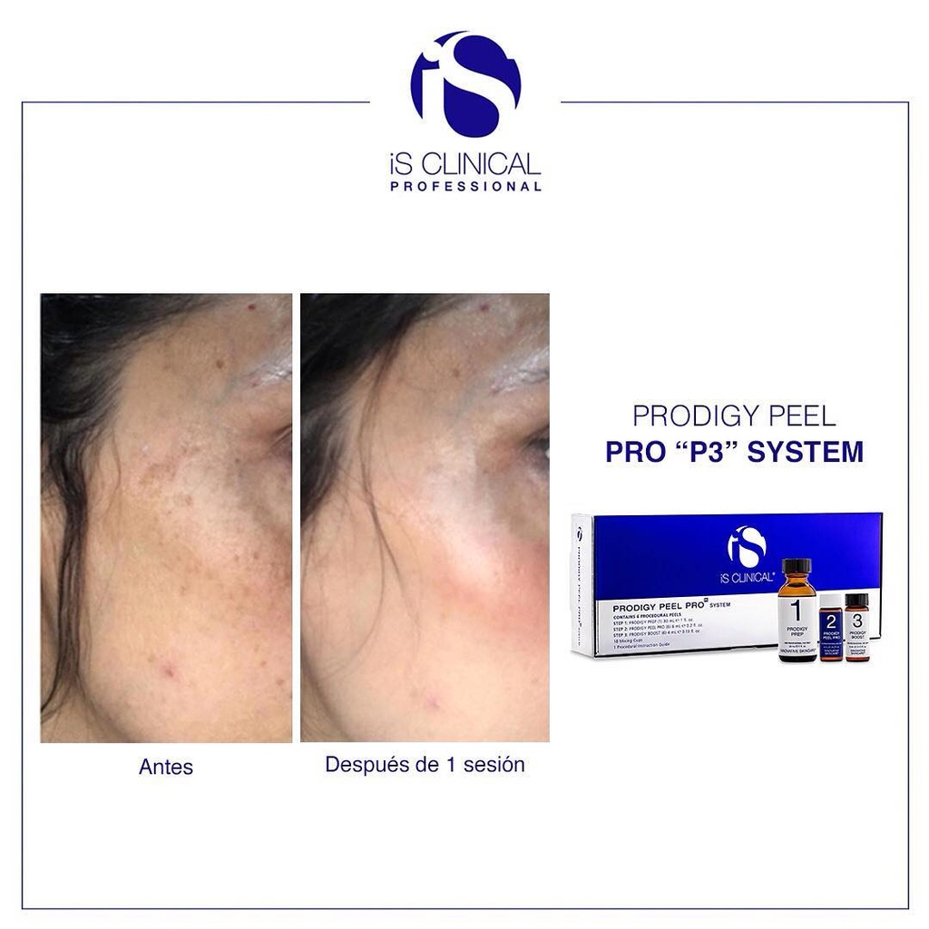 Is Clinical - Prodigy Peel System Pro (P3)