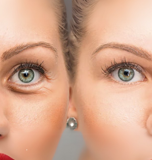 Rejuvenecimiento ojeras - Redensity II