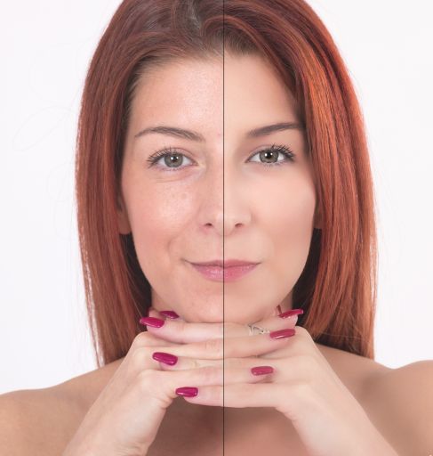 TÉCNICA VIBIA SABINA - Inductor de colágeno